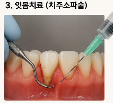 잇몸치료 (치주소파술)