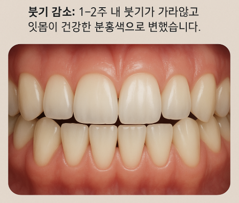 잇몸치료: 붓기 감소